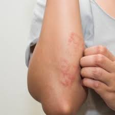 Image of Eczema on a person's forearm